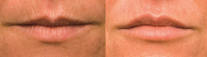 Before and after dermal filler