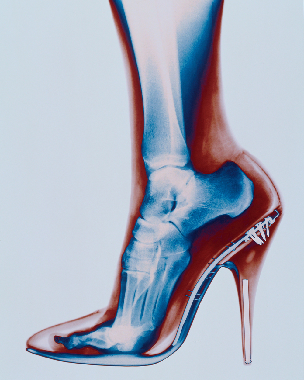 Are your heels causing you long-term damage?