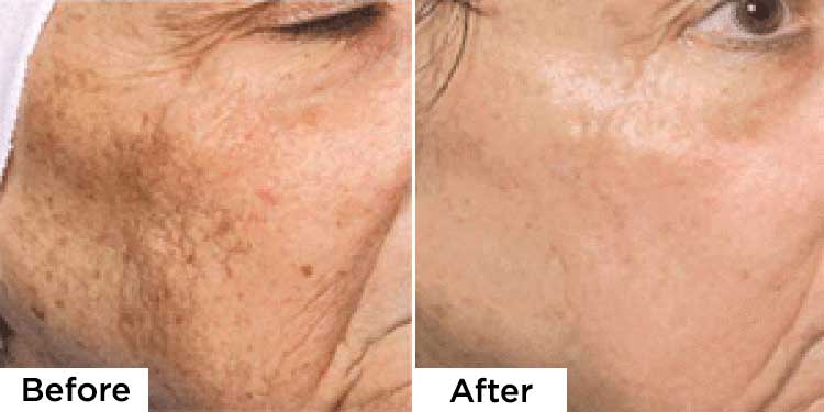 Before and After fractional laser