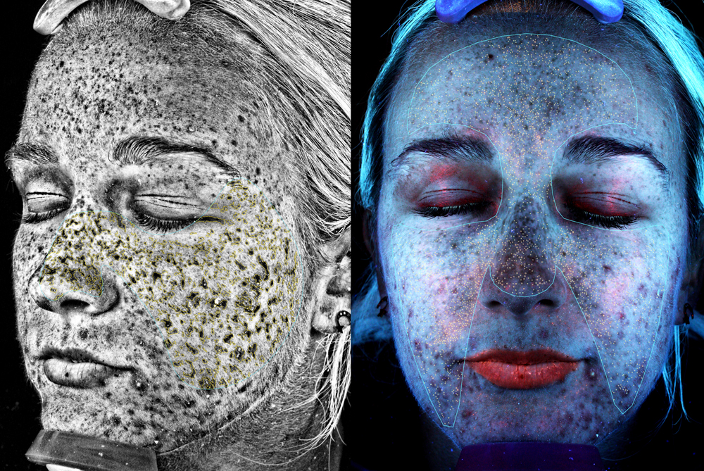 (Left) Visia image showing sun damage. (Right) Visia map of intial porphyrins. 